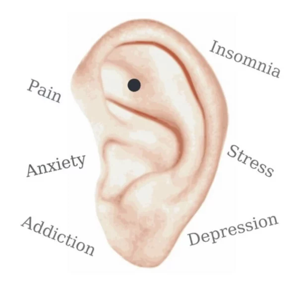 auricular acupuncture in Meridian