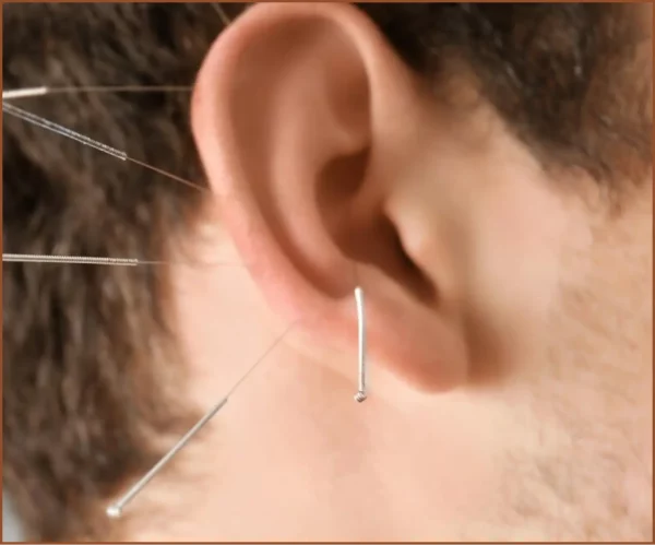 auricular acupuncture in Meridian