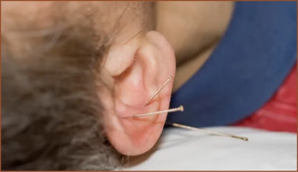 ear acupuncture in Meridian