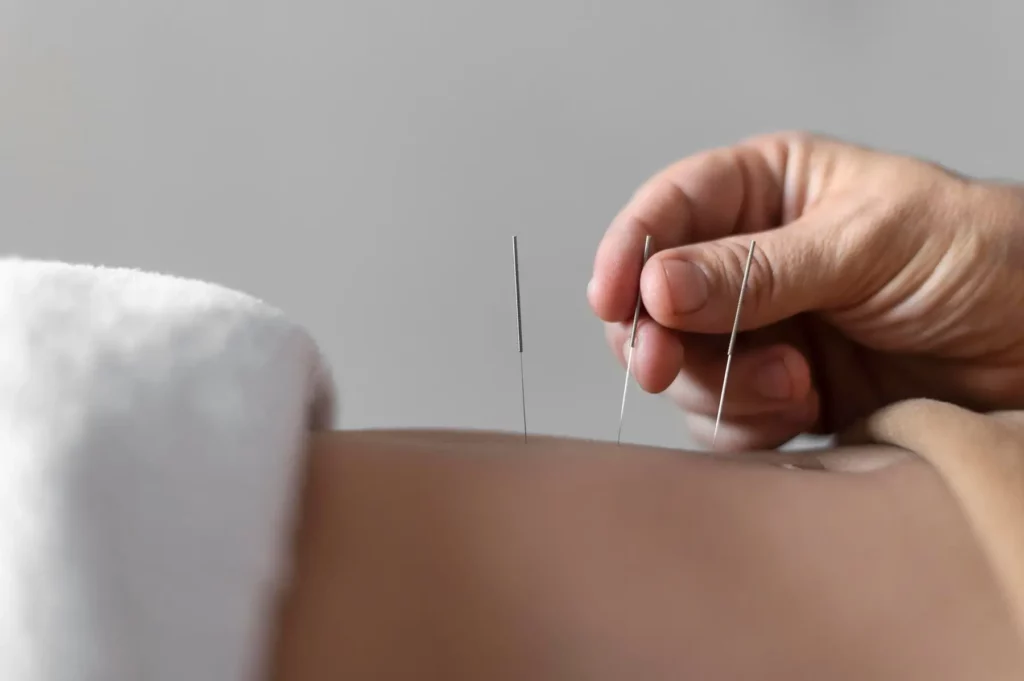 acupuncture in boise, id