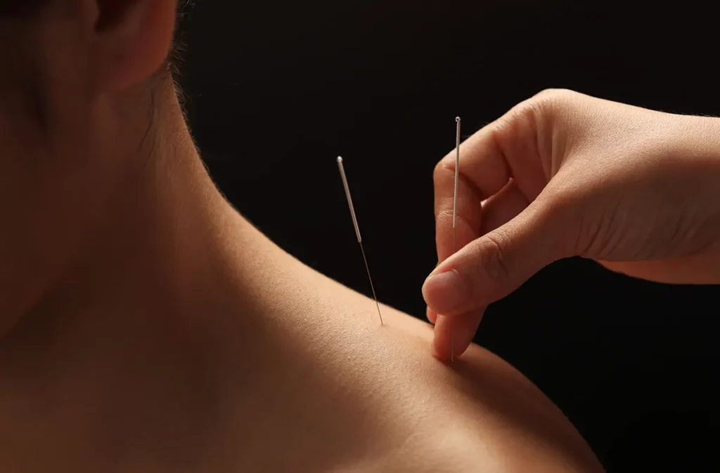 acupuncture for neuropathy