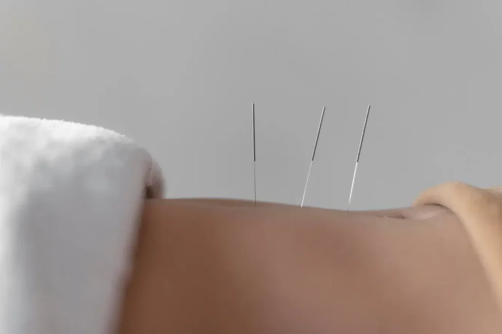 pcos acupuncture treatment