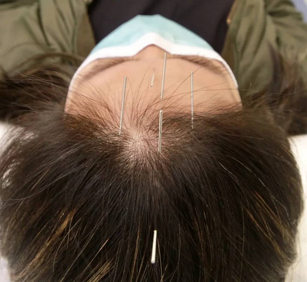 scalp acupuncture near me